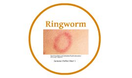 Ringworm by Santana Herbst on Prezi