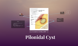 Pilonidal Cyst by Leanna Swanson on Prezi