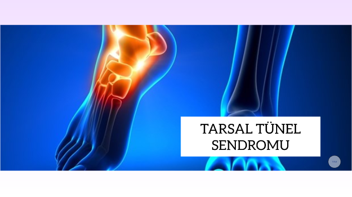 TARSAL TÜNEL SENDROMU by buse özkan on Prezi