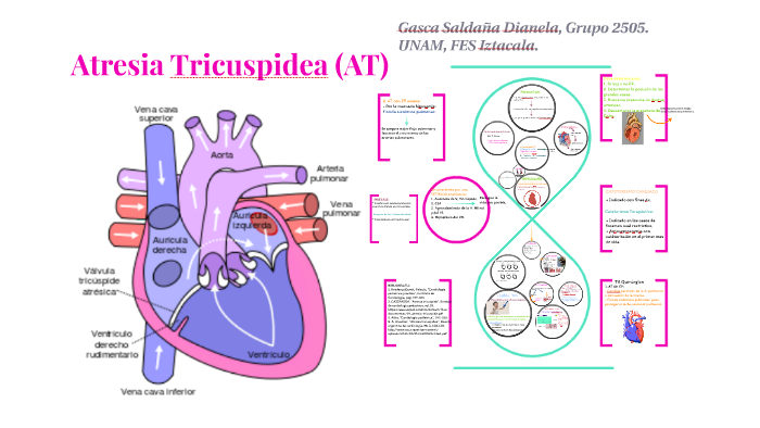 Atresia Tricuspidea by Dianela Gasca Saldaña on Prezi