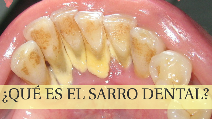 ¿QUÉ ES EL SARRO DENTAL? By Mariselys Salazar On Prezi