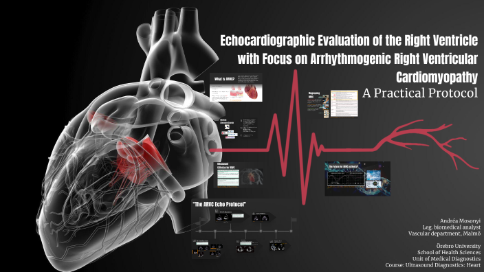 Echocardiography in the Detection of Arrhythmogenic Right Ventricular ...