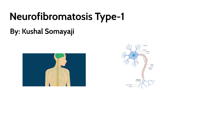 Neurofibromatosis Type 1 By Kushal Somayaji On Prezi