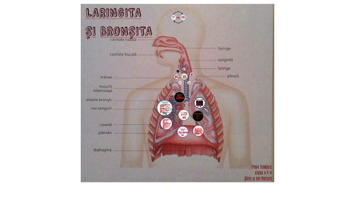 Laringita Si Bronsita By Teodora Popa