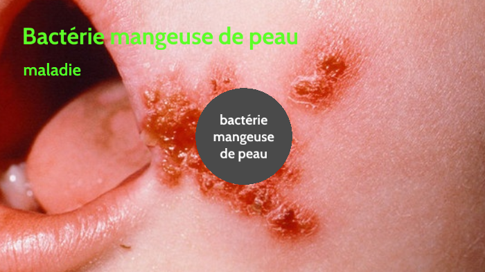 rapha-l-la-bact-rie-mangeuse-de-chair-by-komra1-komra1-on-prezi