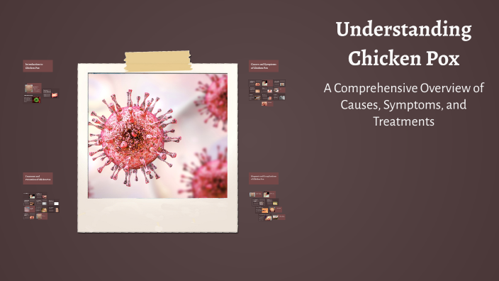 Understanding Chicken Pox by Sagar Adhikari on Prezi