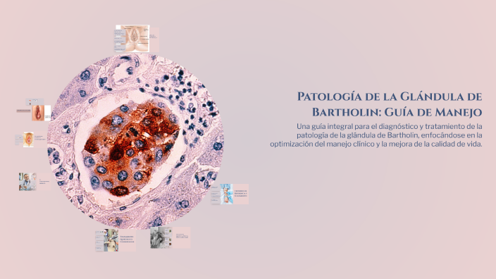 Patología de la Glándula de Bartholin: Guía de Manejo by GUELMI IRIAT ...