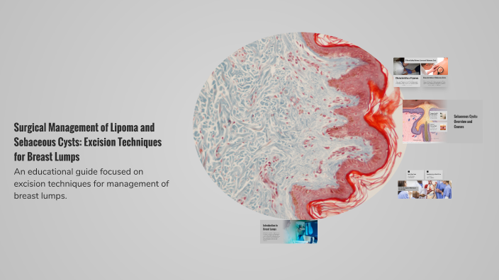Surgical Management of Lipoma and Sebaceous Cysts: Excision Techniques ...