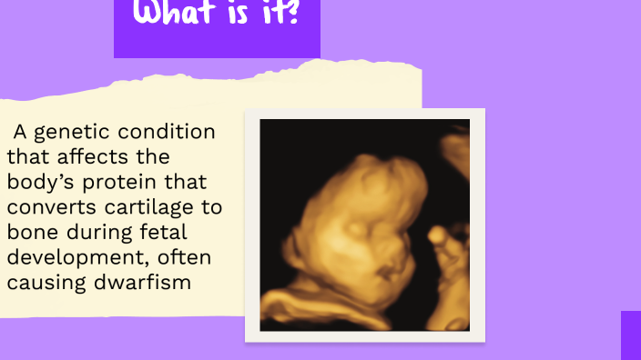 Achondroplasia By J W On Prezi