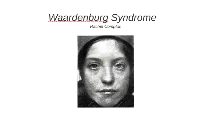 waardenburg syndrome mila kunis