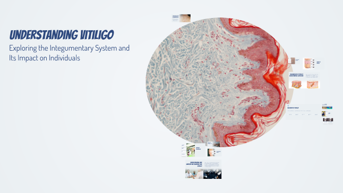 Understanding Vitiligo by ALYNA CHEHAB on Prezi