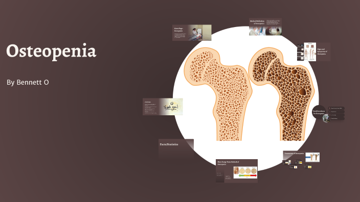 Osteopenia Tibia Understanding Osteopenia: A Comprehensive Overview by shoe sniffer on Prezi