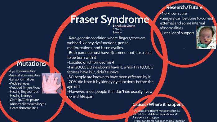 Fraser Syndrome by Makayla Adrianna on Prezi