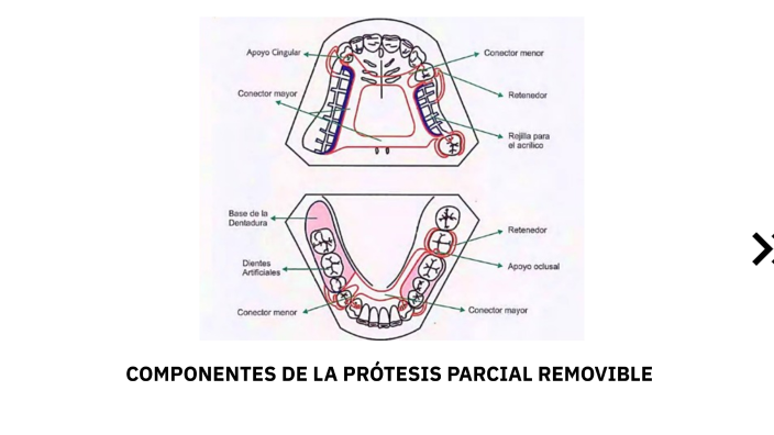 Componentes De Una Protesis Parcial Removible prezi.com