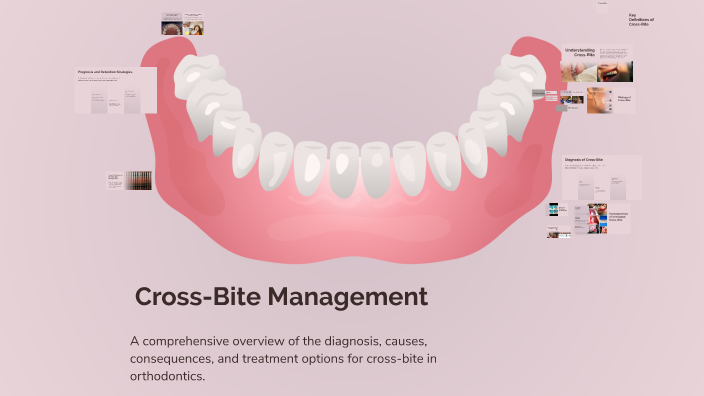 Understanding Cross-Bite: Diagnosis and Management by Sondos Ali3004 on ...