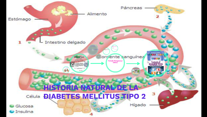 HISTORIA NATURAL DE LA DIABETES MELLITUS TIPO 2 by Angello Sosa on Prezi