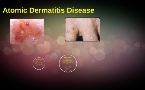 Atomic Dermatitis Disease By Alleysa Enriquez