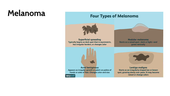 Melanoma by Peter Akintunde-Yale