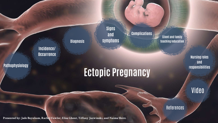 ectopic pregnancy presentation