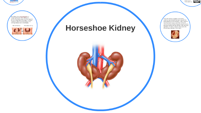 Understanding Horseshoe Kidney