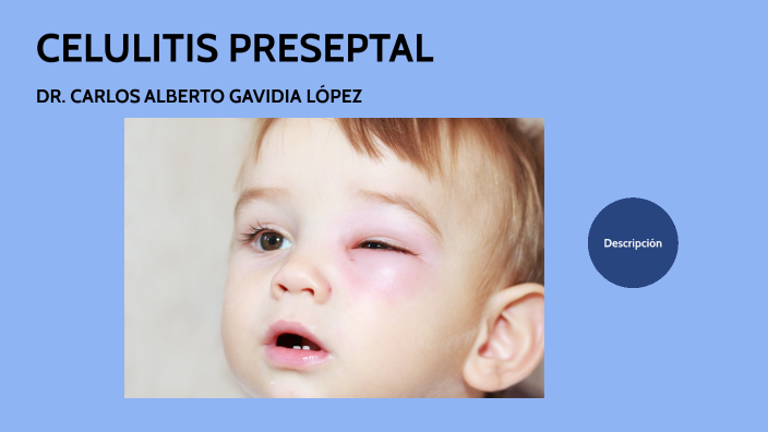 Celulitis preseptal by carlos gavidia on Prezi