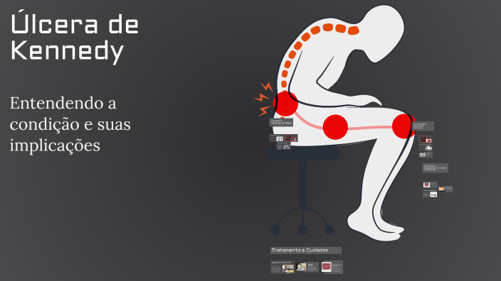 Úlcera de Kennedy by Emerson Mattos on Prezi