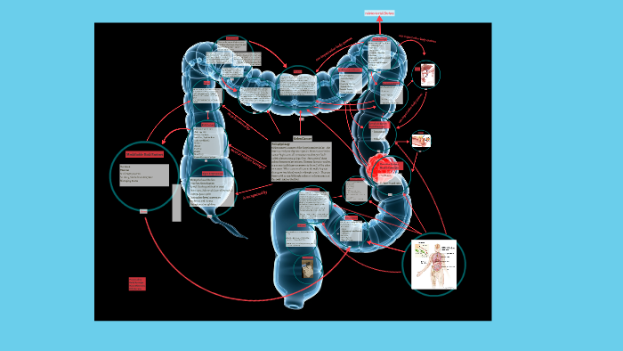 Colon Cancer Concept Map by on Prezi