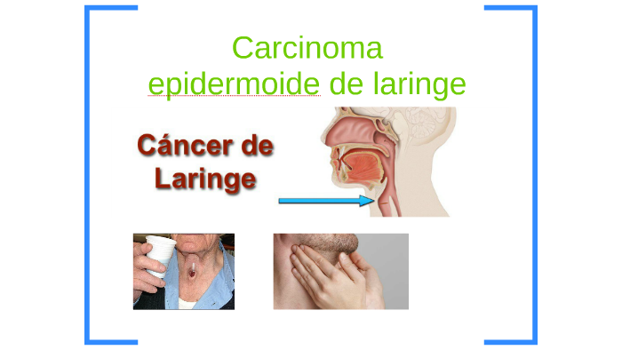 Carcinoma epidermoide de laringe by Alejandra Gonzalez on Prezi