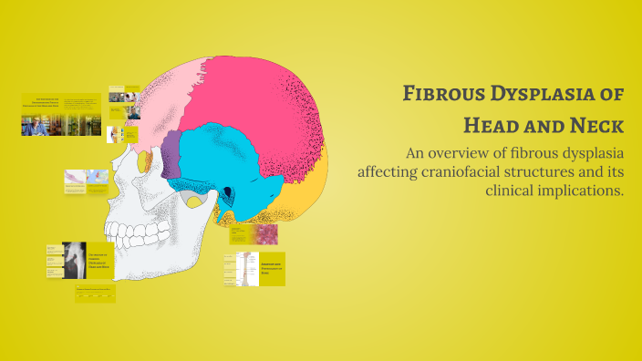 Fibrous Dysplasia Of Head And Neck By Mzukisi Kumsha On Prezi Fibrous Dysplasia Of Head And Neck By Mzukisi Kumsha On Prezi