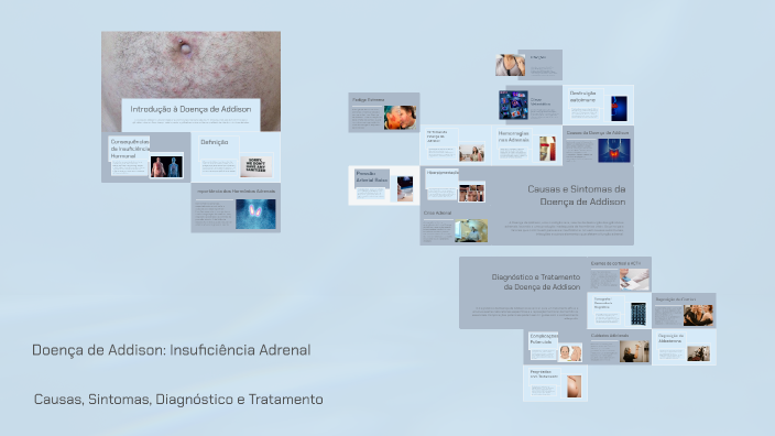 Doença de Addison: Insuficiência Adrenal by Lorrany Cassia on Prezi
