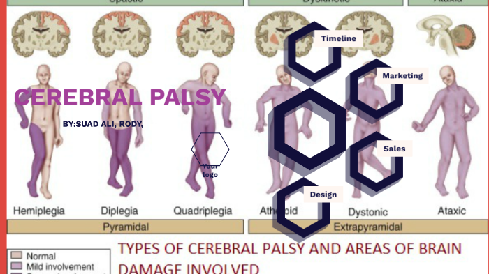 Cerebal Palsy by Suad Ali on Prezi