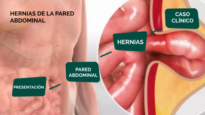 HERNIAS DE LA PARED ABDOMINAL by Stefanía Melo Guevara on Prezi