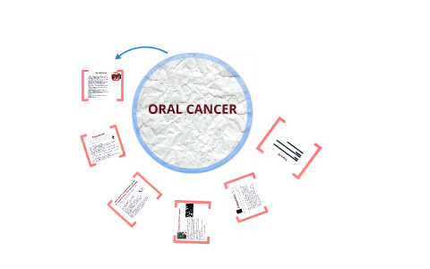 oral cancer case presentation