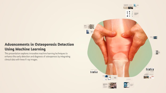 Advancements in Osteoporosis Detection Using Machine Learning by Ridhi ...