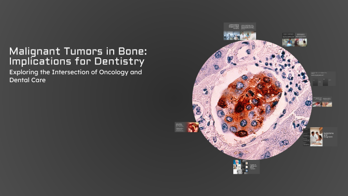 Malignant Tumors in Bone: Implications for Dentistry by بشار الرعود on ...
