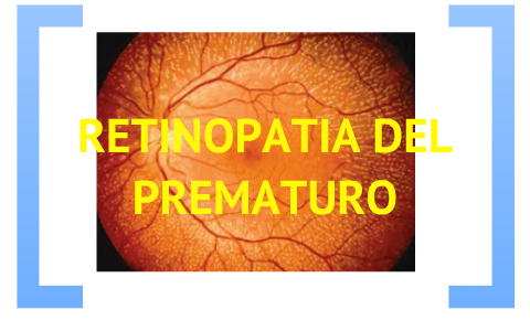 RETINOPATIA DEL PREMATURO By Marcela Castillo