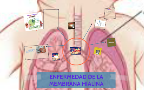 Enfermedad De La Membrana Hialina By Lizzeth Cruz On Prezi