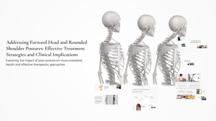 Addressing Forward Head and Rounded Shoulder Postures: Effective ...