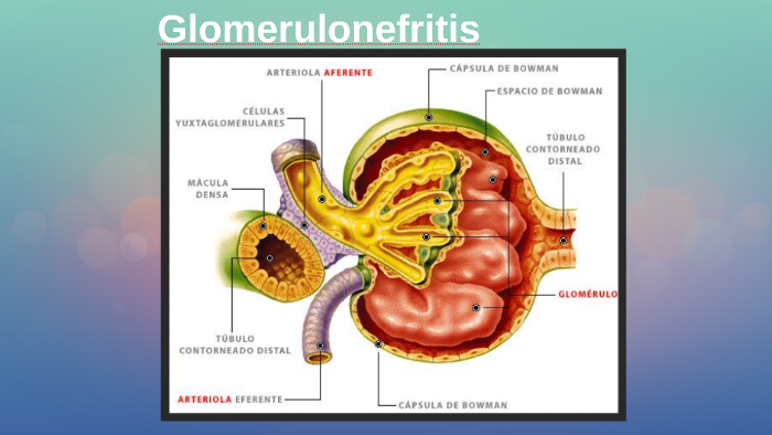 Glomerulonefritis by Carla Rovira Aguilà