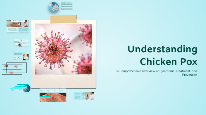 Understanding Chicken Pox by Ashton Mikhail Malabonga on Prezi