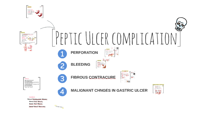 Peptic Ulcer Complication By Ahmad Shamy On Prezi