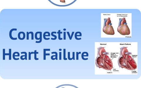 Congestive Heart Failure by Casey Vogel