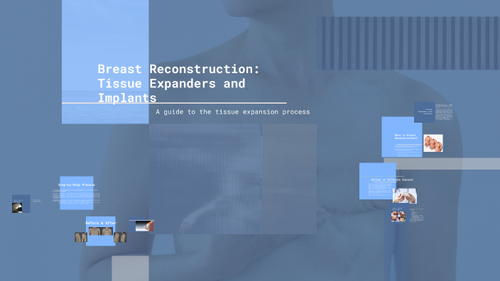 Breast Reconstruction with Tissue Expanders and Implants by chantal ...
