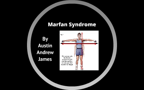 Marfan Syndrome by Andrew Faryniarz