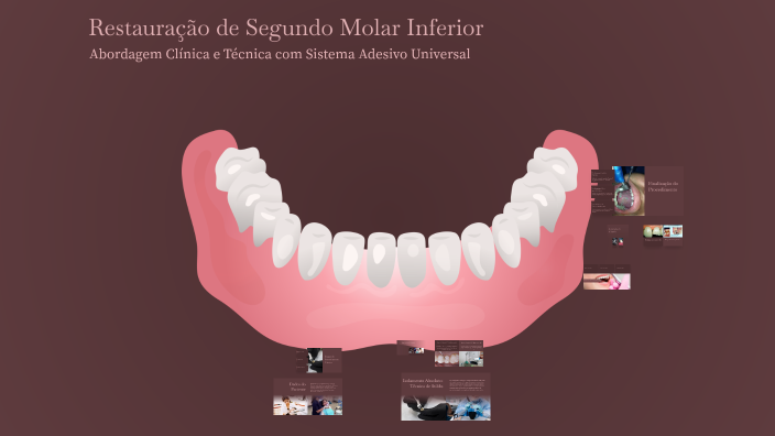 Restauração de Segundo Molar Inferior by VITOR LOPES on Prezi