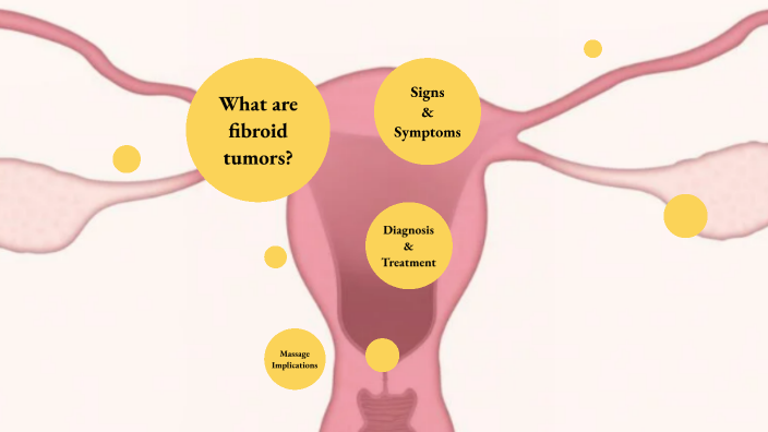 Fibroid Tumors by Lacey Tompkins