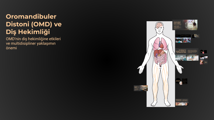 Oromandibuler Distoni (OMD) ve Diş Hekimliği by ibrahim kittana on Prezi
