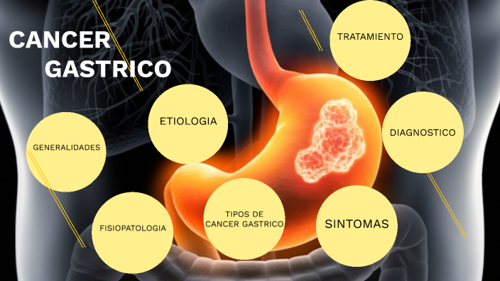 CA gastrico by MANUEL ANTONIO CORTEZ MOXNAY on Prezi