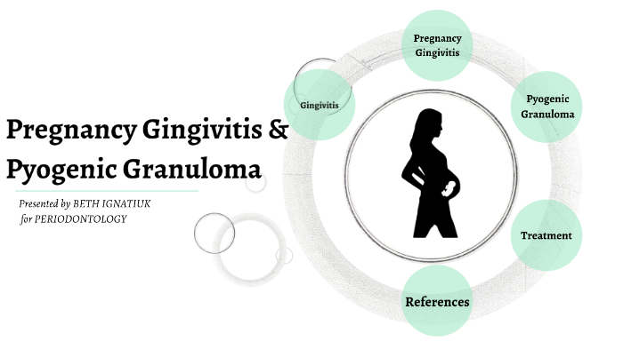 Pregnancy Gingivitis And Pyogenic Granuloma By Beth Ignatiuk On Prezi 4359