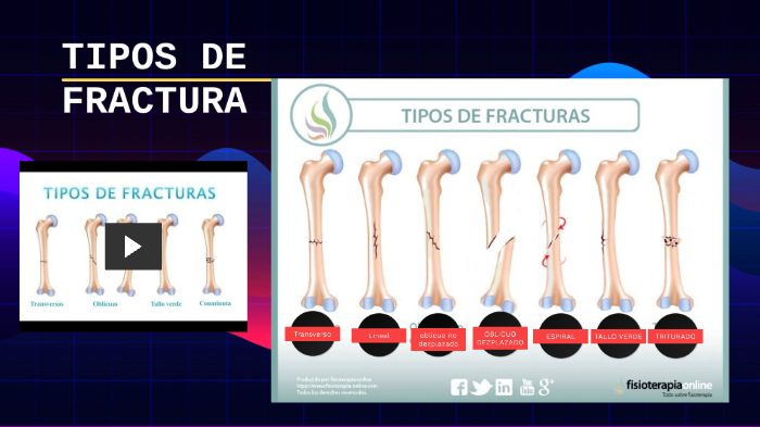 tipos de fractura by jorge hernandez on Prezi